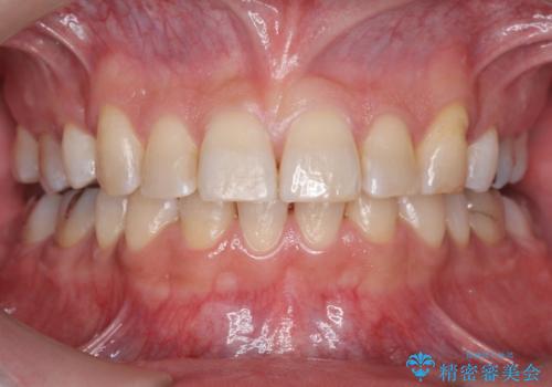 前歯だけ治したい インビザライン・ライト 30代男性の症例 治療後