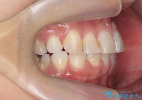 前歯だけ治したい インビザライン・ライト 30代男性の治療後