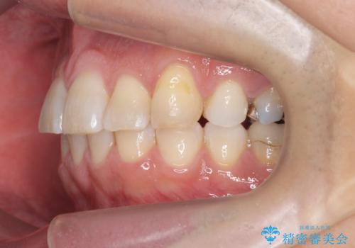 前歯だけ治したい インビザライン・ライト 30代男性の治療後