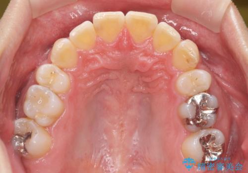 前歯だけ治したい インビザライン・ライト 30代男性の治療後