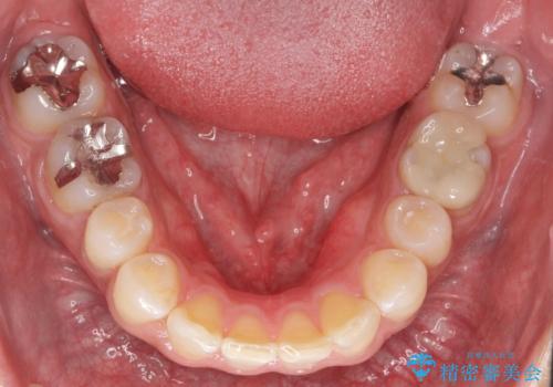 前歯だけ治したい インビザライン・ライト 30代男性の治療後