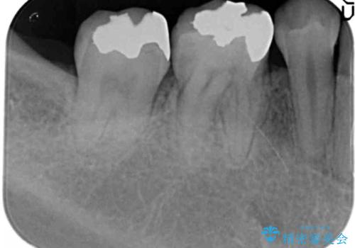 銀歯を白く　セラミックインレー治療の治療前