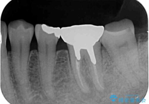噛むと痛い銀歯　根管治療を伴うやりかえの治療前