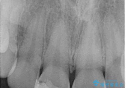 転倒して欠けてしまった前歯をオールセラミッククラウンで自然な口元にの治療前