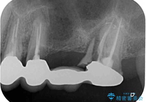 抜歯が必要な左右の奥歯 ブリッジとインプラントによる奥歯の補綴治療の治療前