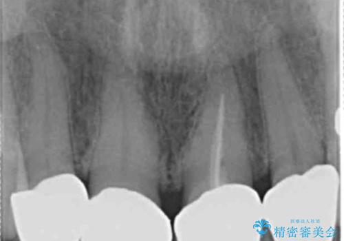 長持ちするセラミック 5年経過症例 50代女性の治療前