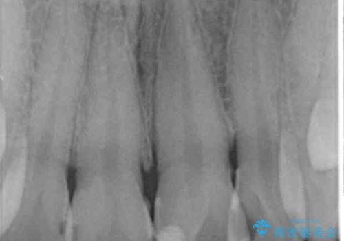 前歯をきれいにしたい 20代女性の治療前