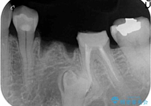 大人になってからの乳歯脱落 セラミックブリッジによる補綴の治療中