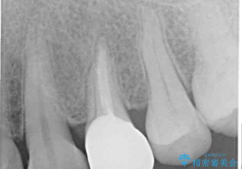 食事をするときに痛む 根管治療とセラミック補綴治療の治療後