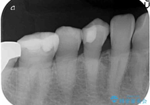 歯が欠けて舌が引っかかる セラミックインレー 50代女性の治療後