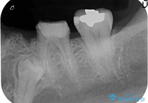 大人になってからの乳歯脱落 セラミックブリッジによる補綴の治療中