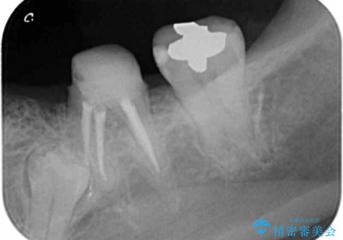大人になってからの乳歯脱落 セラミックブリッジによる補綴の治療中