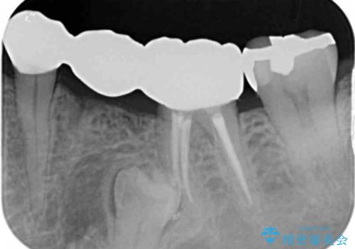 大人になってからの乳歯脱落 セラミックブリッジによる補綴の治療後