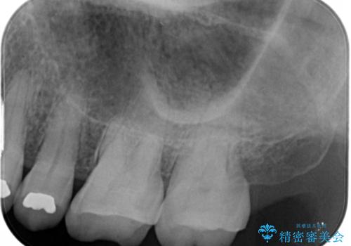 大きな詰め物を被せ物に変えて、歯の破折リスクを減らすの治療前