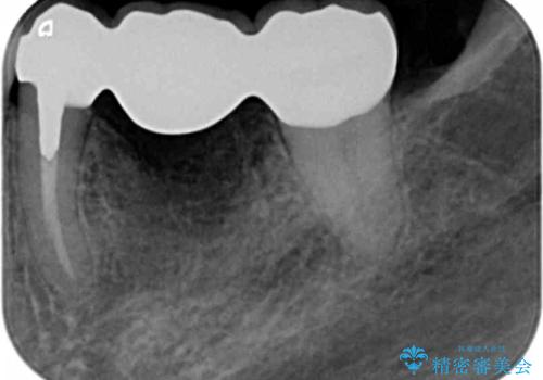 [ 歯牙破折 ]  違和感のある大臼歯 ブリッジ治療の治療後