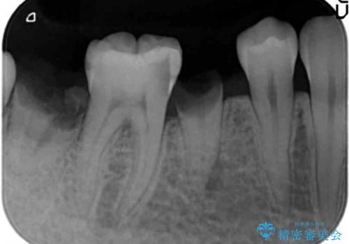 歯が折れた 低予算でオールセラミックのブリッジ 20代女性の治療前