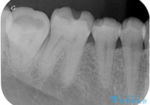 海外赴任前に気になる虫歯を治療したいの治療前