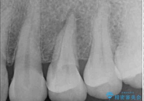 食事をするときに痛む 根管治療とセラミック補綴治療の治療前