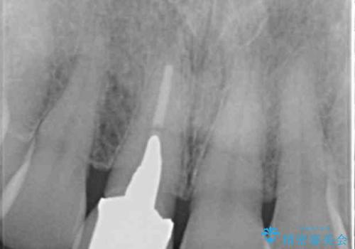 セラミッククラウン 歯ぐきの黒ずみの改善の治療前