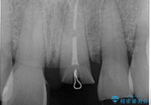 折れた前歯を使えるように、抜かないで残す方法の治療前