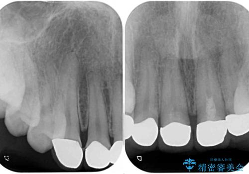 不揃いな前歯のセラミックが気になる オールセラミッククラウンによる補綴治療の治療前