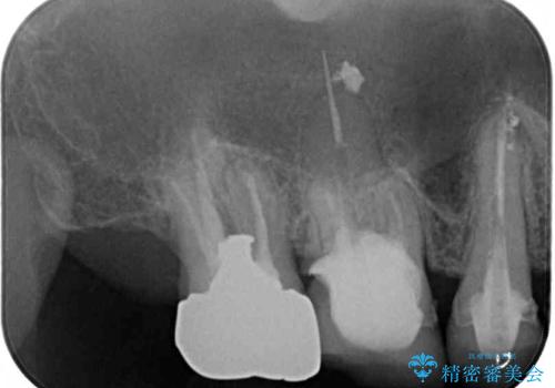 抜歯が必要な左右の奥歯 ブリッジとインプラントによる奥歯の補綴治療の治療前