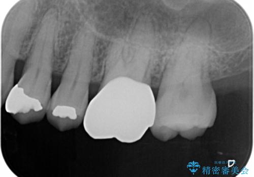 大きな詰め物を被せ物に変えて、歯の破折リスクを減らすの治療後