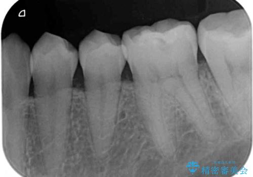 海外赴任前に気になる虫歯を治療したいの治療前