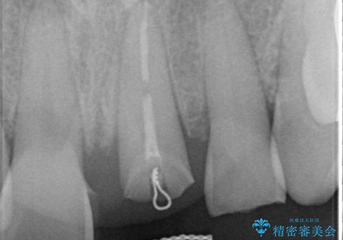 折れた前歯を使えるように、抜かないで残す方法の治療後