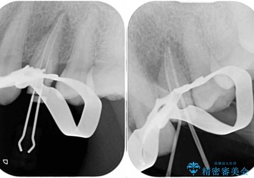 食事をするときに痛む 根管治療とセラミック補綴治療の治療中