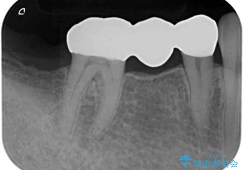 歯が折れた 低予算でオールセラミックのブリッジ 20代女性の治療後
