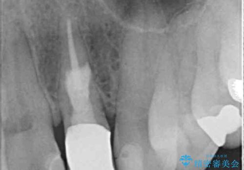 歯の外部吸収　難しい根の治療　30代男性の治療中