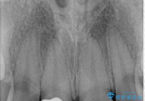 転倒して欠けてしまった前歯をオールセラミッククラウンで自然な口元にの治療後