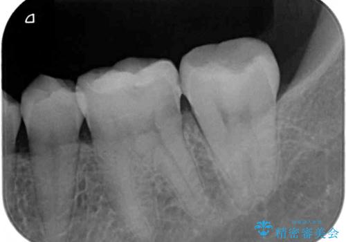 海外赴任前に気になる虫歯を治療したいの治療後