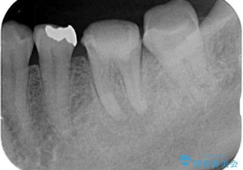 噛むと痛い銀歯　根管治療を伴うやりかえの治療中