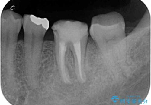 噛むと痛い銀歯 根管治療を伴うやりかえの治療中
