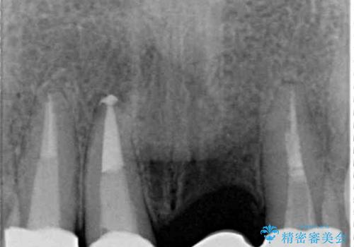 抜かなければいけない前歯 歯肉移植を用いたオールセラミックブリッジの治療後