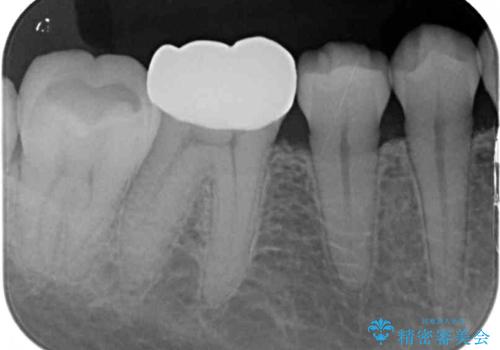 海外赴任前に気になる虫歯を治療したいの治療後