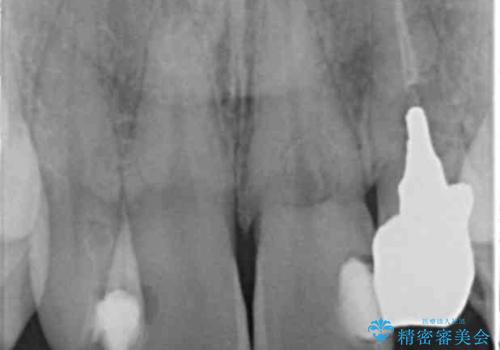 歯の外部吸収　難しい根の治療　30代男性の症例 治療前