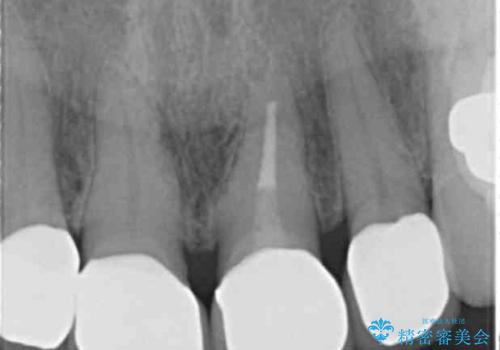 長持ちするセラミック 5年経過症例 50代女性の治療中
