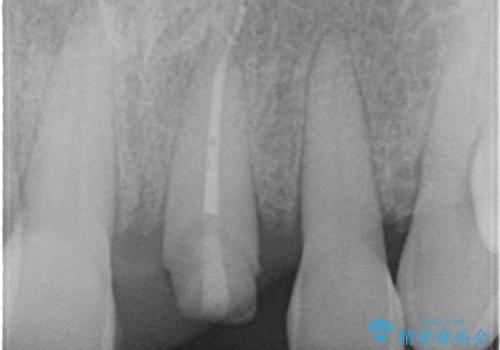 折れた前歯を使えるように、抜かないで残す方法の治療中
