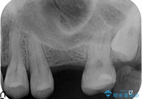 前歯が反対になっている　マウスピース矯正+奥歯ブリッジの治療前