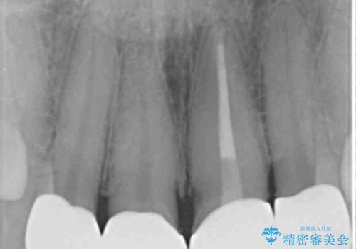 前歯をきれいにしたい 20代女性の治療後