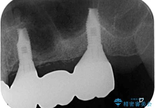 抜歯が必要な左右の奥歯 ブリッジとインプラントによる奥歯の補綴治療の治療後