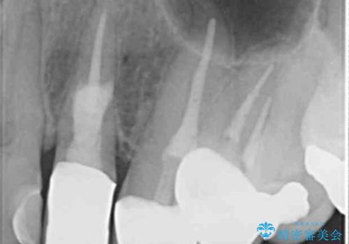 歯の外部吸収　難しい根の治療　30代男性の症例 治療後