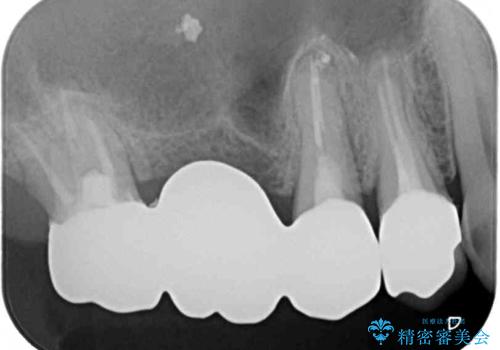 抜歯が必要な左右の奥歯 ブリッジとインプラントによる奥歯の補綴治療の治療後