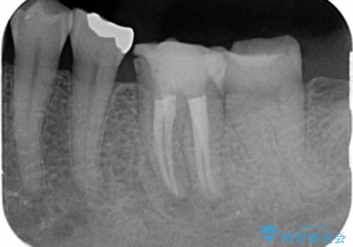 噛むと痛い銀歯　根管治療を伴うやりかえの治療中