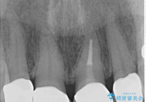 長持ちするセラミック 5年経過症例 50代女性の治療後