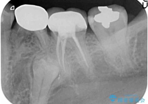 大人になってからの乳歯脱落 セラミックブリッジによる補綴の治療前