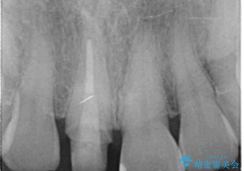 セラミッククラウン 歯ぐきの黒ずみの改善の治療中
